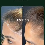 Minoxidil – Hair Growth Serum for Microneedling - Image 5