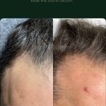 Minoxidil – Hair Growth Serum for Microneedling - Image 6