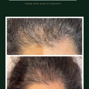 Inpen Microneedling Device