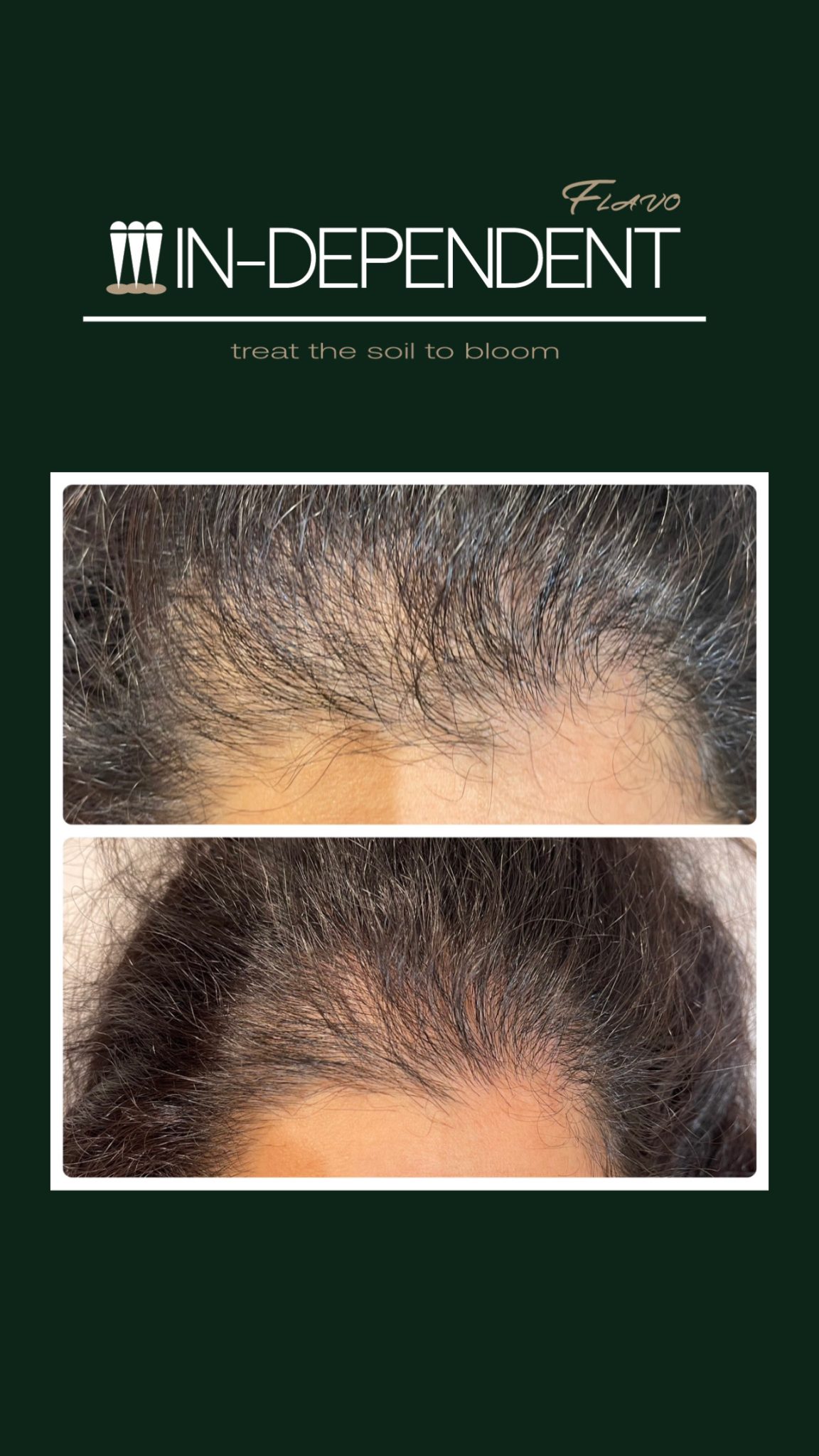 Inpen Microneedling Device