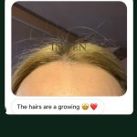 Minoxidil – Hair Growth Serum for Microneedling - Image 8