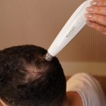 Minoxidil – Hair Growth Serum for Microneedling - Image 2